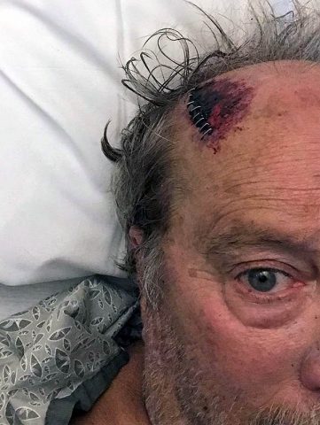 Hank after Motorcycle Accident